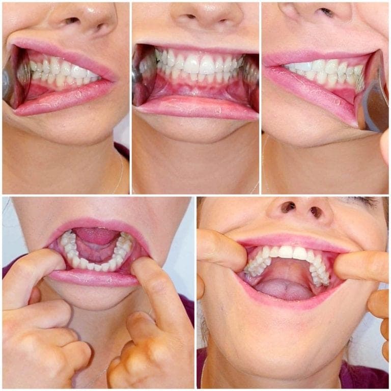 Example collage showing the five dental selfie angles
